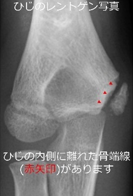 ひじ離れた骨端線