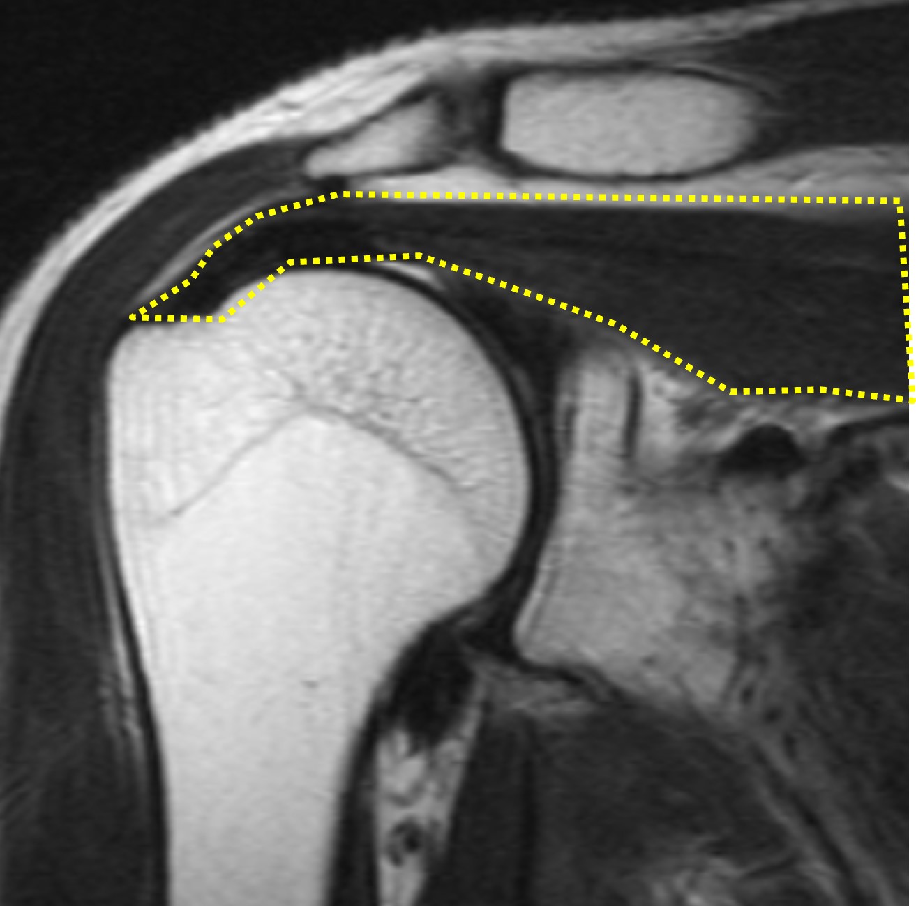 右肩MRI:腱板断裂(正常)