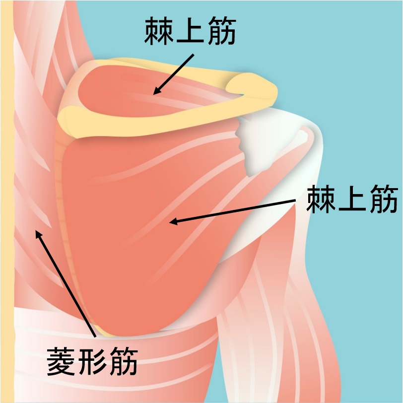 大きな腱板断裂