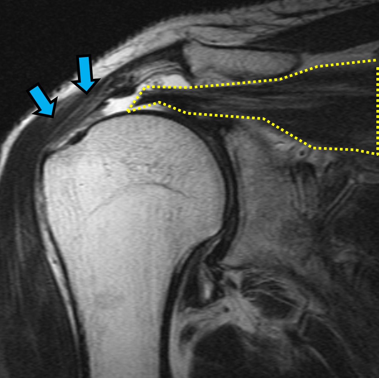 右肩MRI:腱板断裂