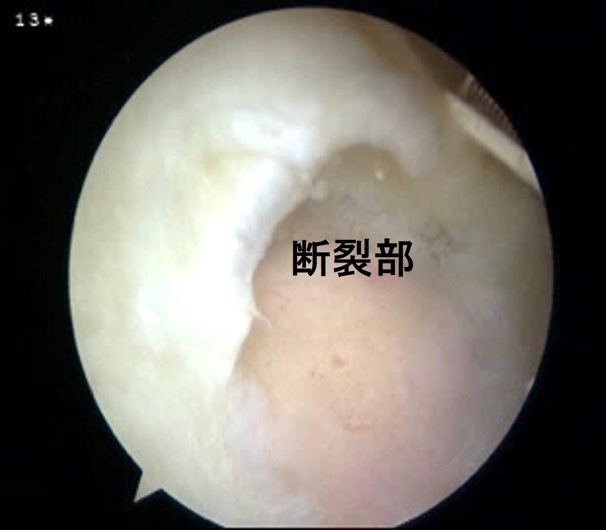 小断裂:修復前