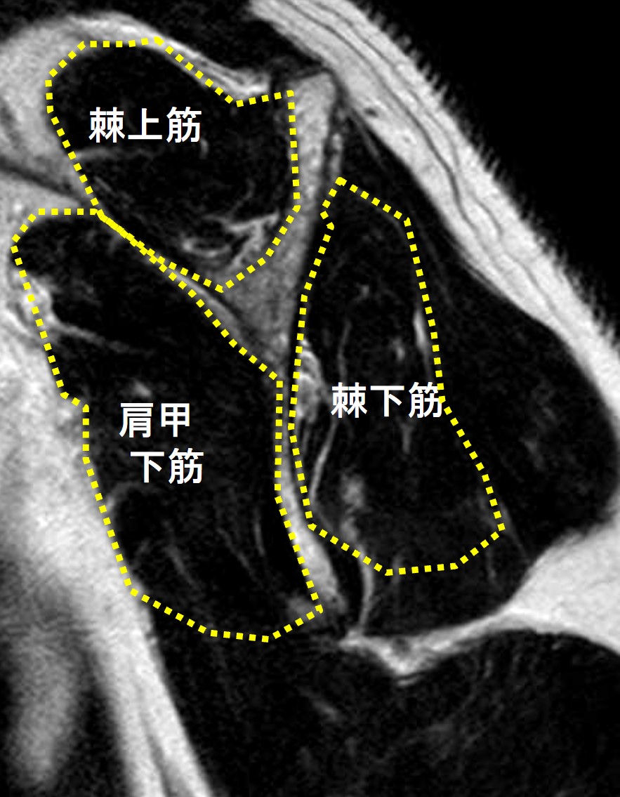 左肩MRI:筋萎縮なし(正常)