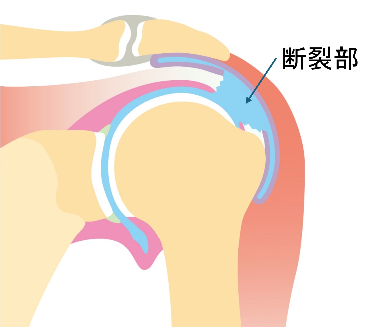 断裂部